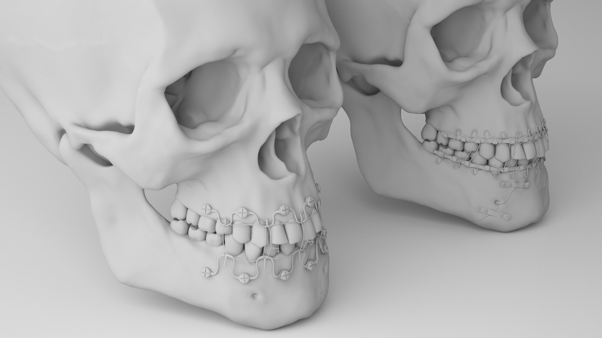 Male Skull - Mandible fracture 3D model https://p.turbosquid.com/ts-thumb/W6/IoJ3xH/WH/mandiblefracturepack12/jpg/1726988324/1920x1080/fit_q87/2be30bcc85280324f2345f39b250f2abf39490b1/mandiblefracturepack12.jpg