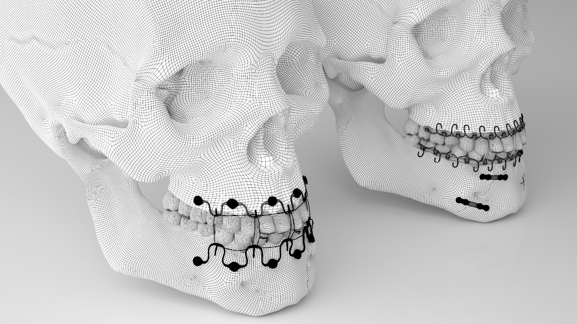 Male Skull - Mandible fracture 3D model https://p.turbosquid.com/ts-thumb/W6/IoJ3xH/Xe/mandiblefracturepack13/jpg/1726988325/1920x1080/fit_q87/f5195967578b312f3d96f57ab474a0fefc4ac564/mandiblefracturepack13.jpg