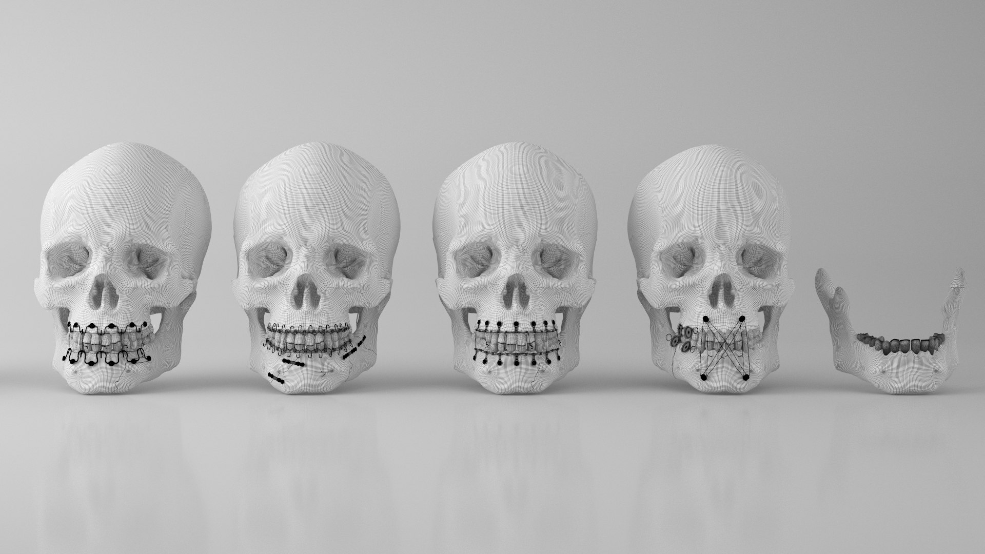 Male Skull - Mandible fracture 3D model https://p.turbosquid.com/ts-thumb/W6/IoJ3xH/ZK/mandiblefracturepack11/jpg/1726988360/1920x1080/fit_q87/662261b24882d54e2ca92d3e9037153ffebe20db/mandiblefracturepack11.jpg