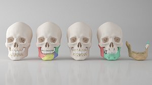 Male Skull - Mandible fracture