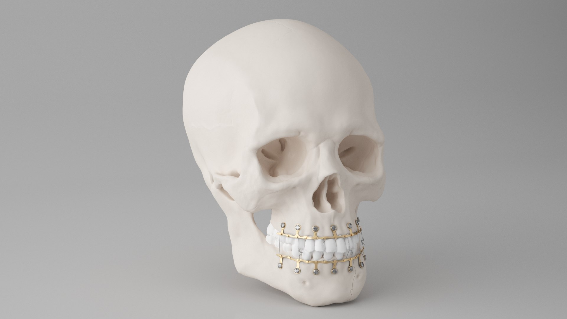 Male Skull - Mandible fracture 3D model https://p.turbosquid.com/ts-thumb/W6/IoJ3xH/e1/mandiblefracturepack04/jpg/1726988321/1920x1080/fit_q87/d66cf6985f6afc9f90677c141428b85a6fb9ac57/mandiblefracturepack04.jpg