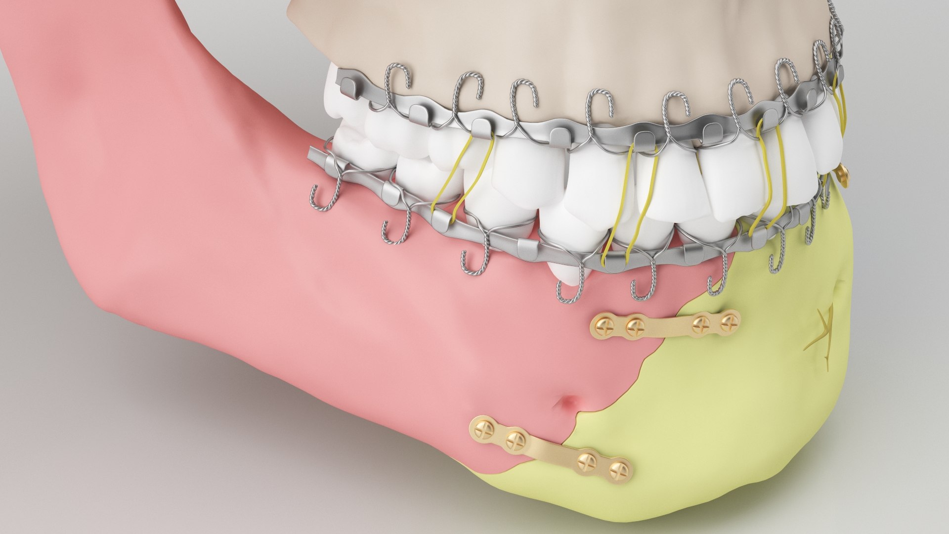 Male Skull - Mandible fracture 3D model https://p.turbosquid.com/ts-thumb/W6/IoJ3xH/f2/mandiblefracture04/jpg/1726988318/1920x1080/fit_q87/bb5ac115a142d1c6105b11c412d79c3c14cb632d/mandiblefracture04.jpg
