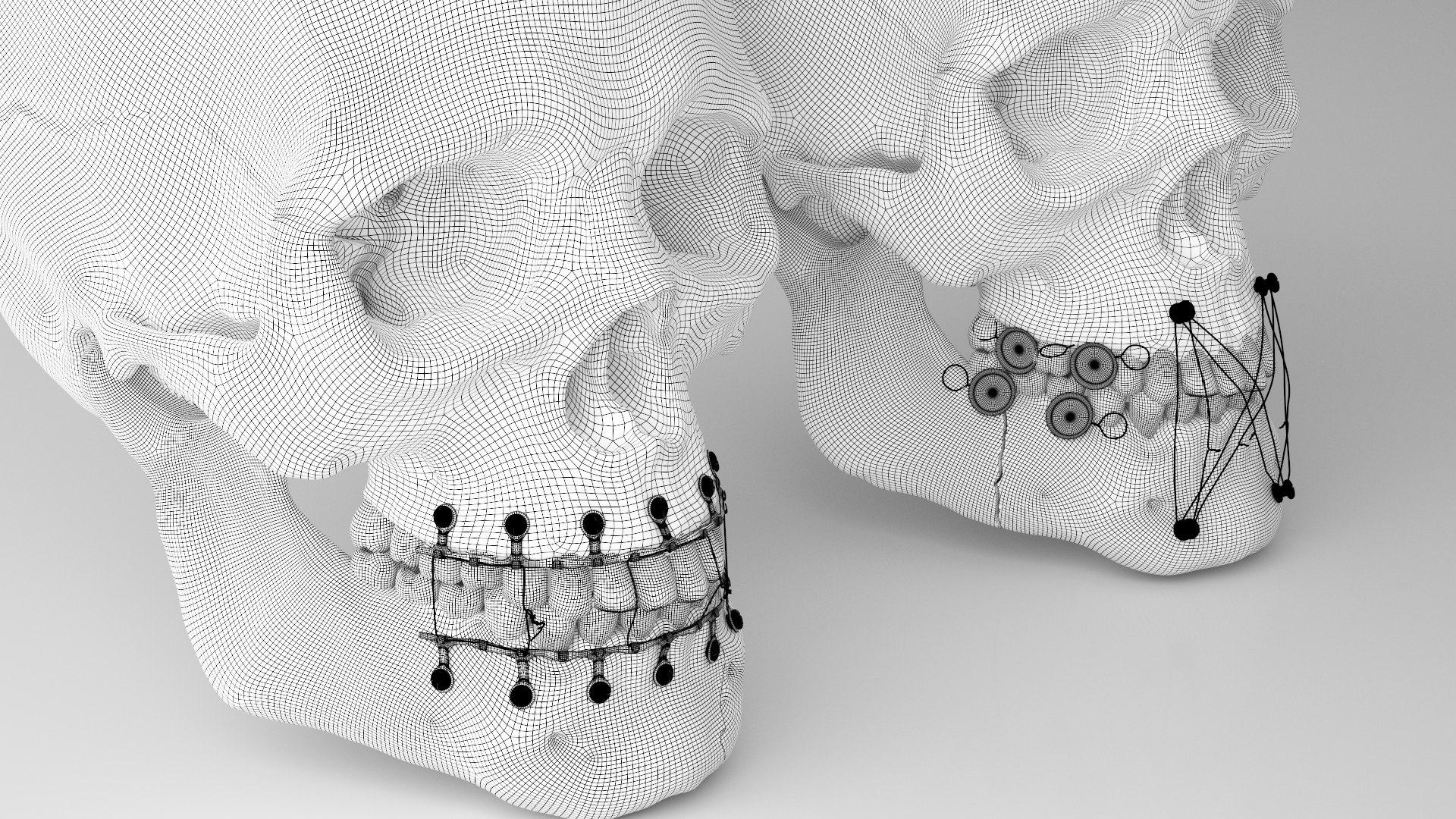 Male Skull - Mandible fracture 3D model https://p.turbosquid.com/ts-thumb/W6/IoJ3xH/fC/mandiblefracturepack15/jpg/1726988326/1920x1080/fit_q87/a8fa2f167f27693ca5ab445e266e07cffdb852be/mandiblefracturepack15.jpg