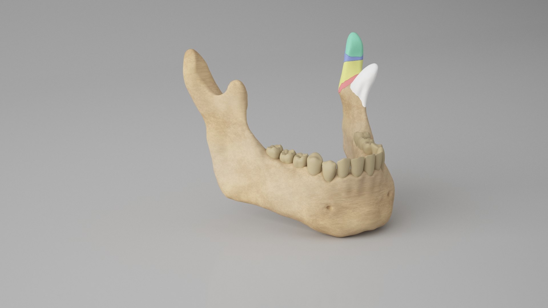 Male Skull - Mandible fracture 3D model https://p.turbosquid.com/ts-thumb/W6/IoJ3xH/yo/mandiblefracturepack06/jpg/1726988322/1920x1080/fit_q87/1ac1cc01510c2873483124330033b64027844b69/mandiblefracturepack06.jpg