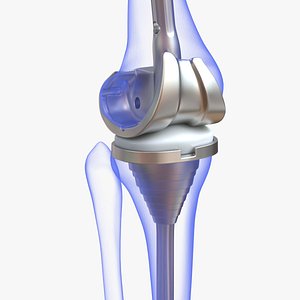 3D Knee Replacement Implant