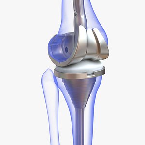 Knee Replacement Implant