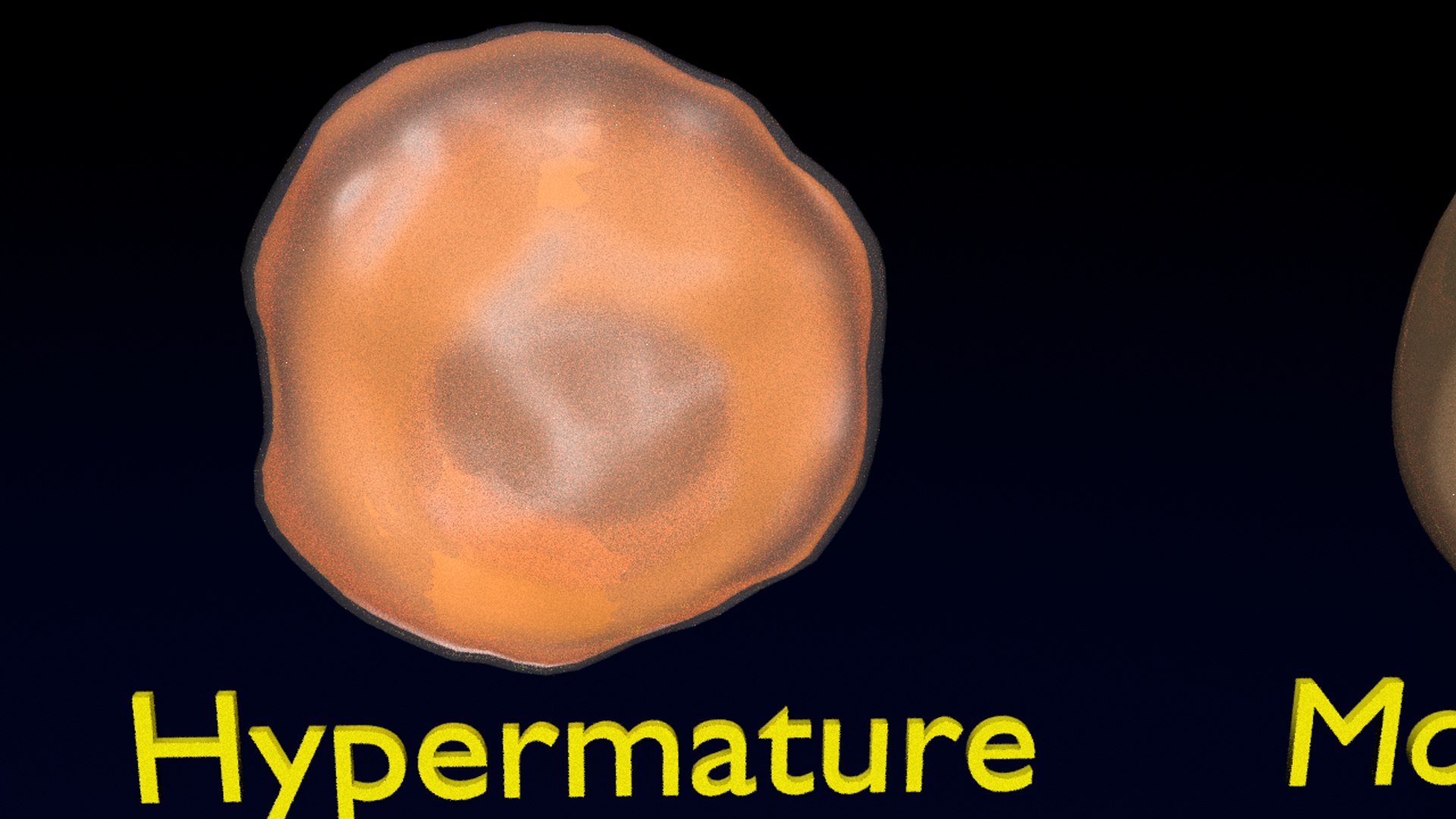 3D cataract eye lens types detailed animated model - TurboSquid 1774837