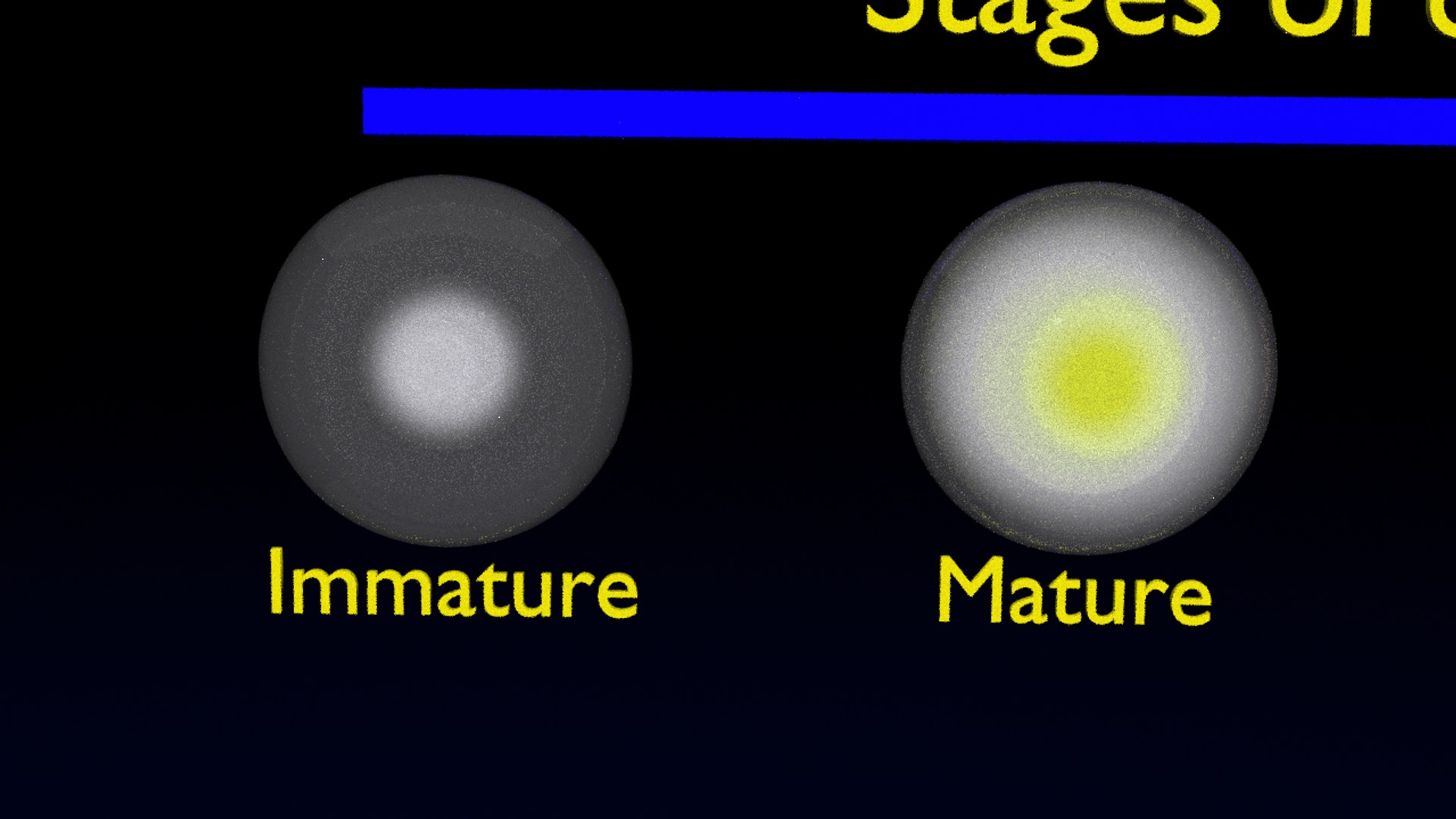 3D cataract eye lens types detailed animated model - TurboSquid 1774837
