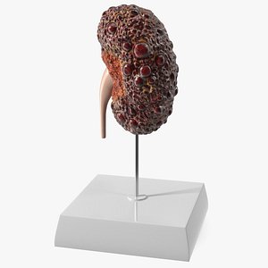 3D Polycystic Kidney Disease Model on Stand