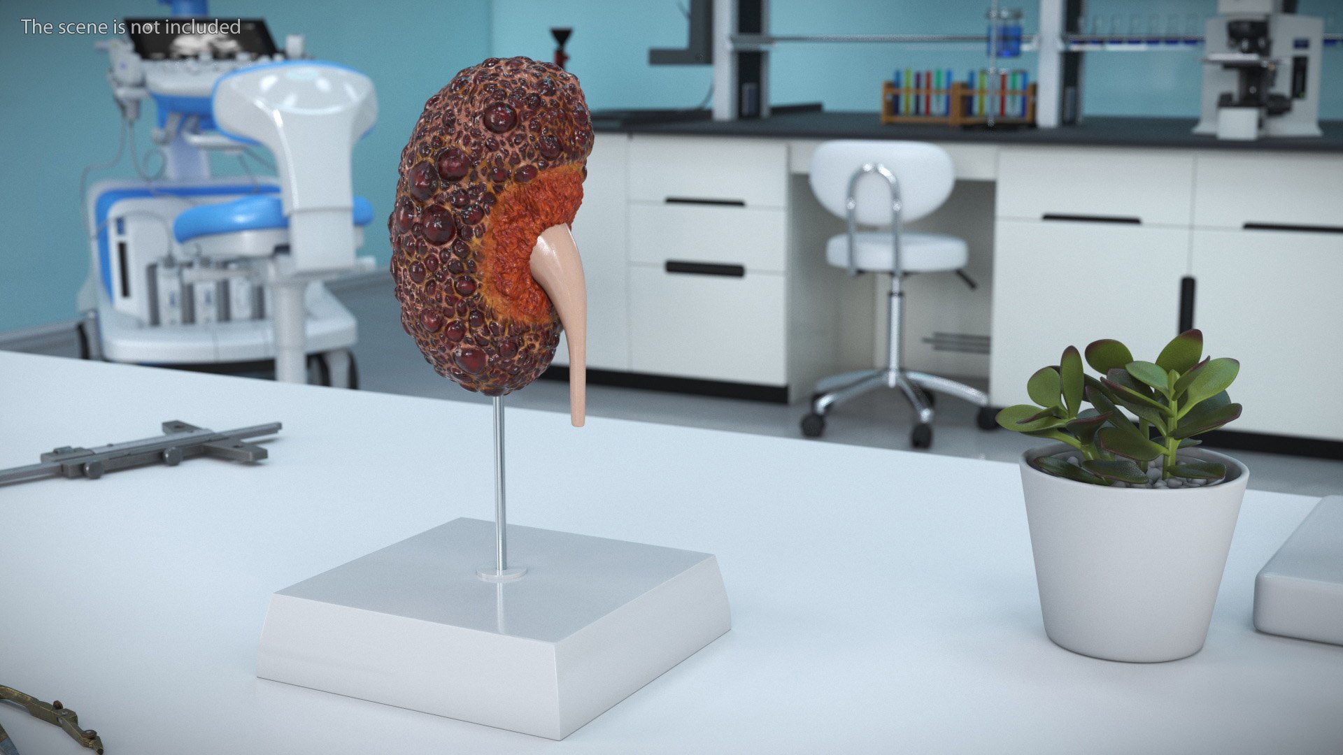 3D Polycystic Kidney Disease Model On Stand - TurboSquid 2411099