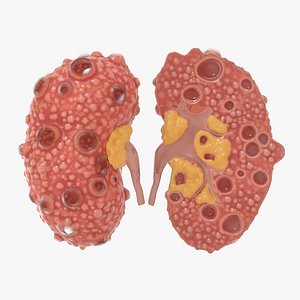 3D polycystic kidney