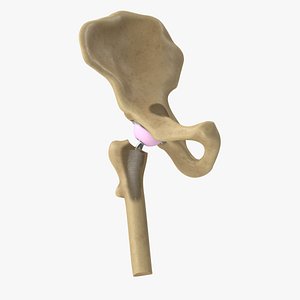 Hip Bone Replacement Surgery V02 3D model