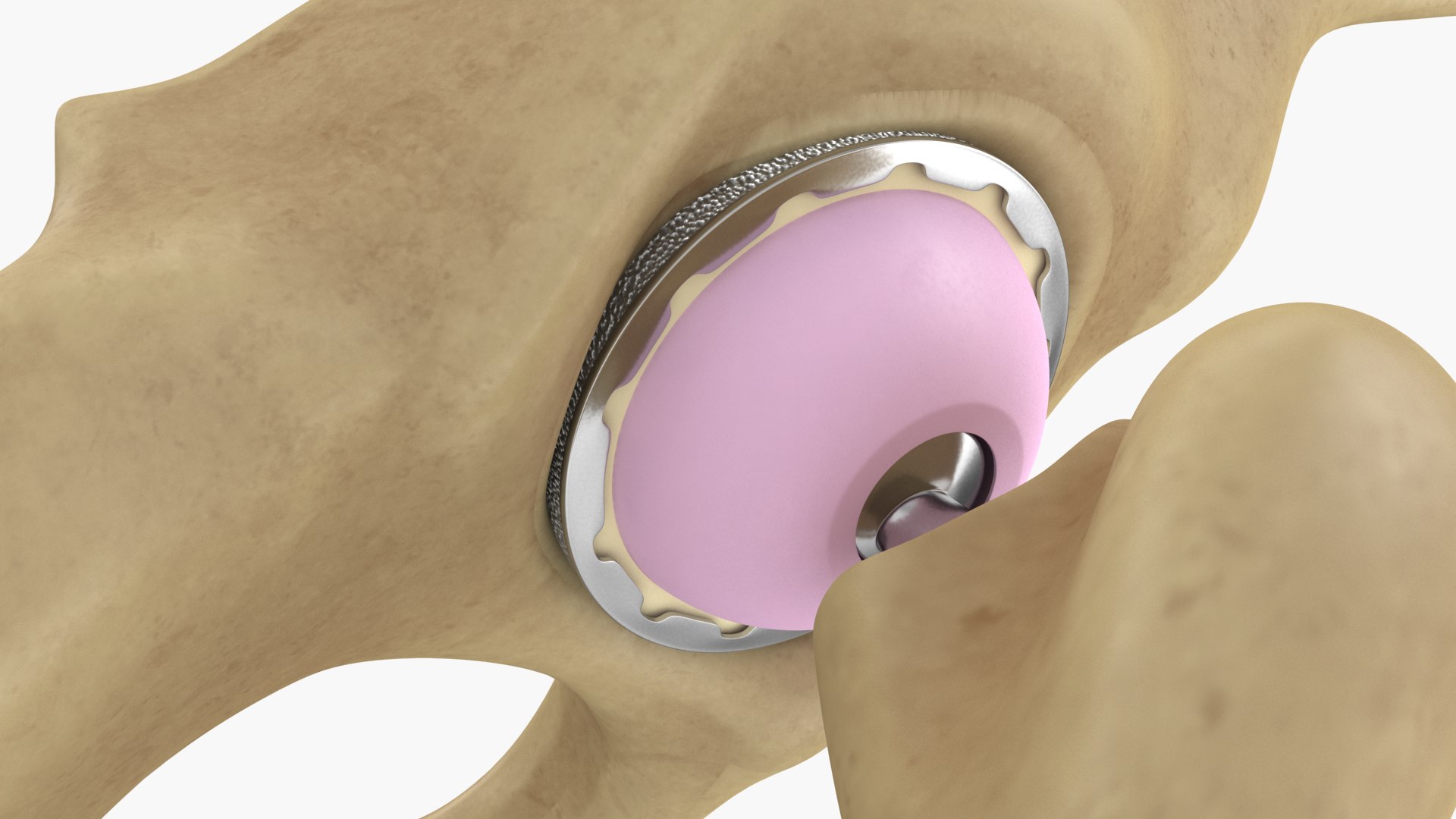 Hip Bone Replacement Surgery V02 3D Model - TurboSquid 1744809
