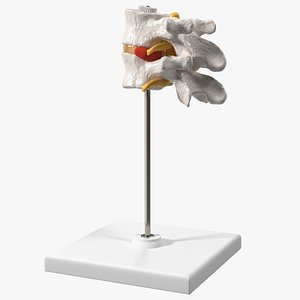 3D Stand with Herniated Spinal Vertebrae model