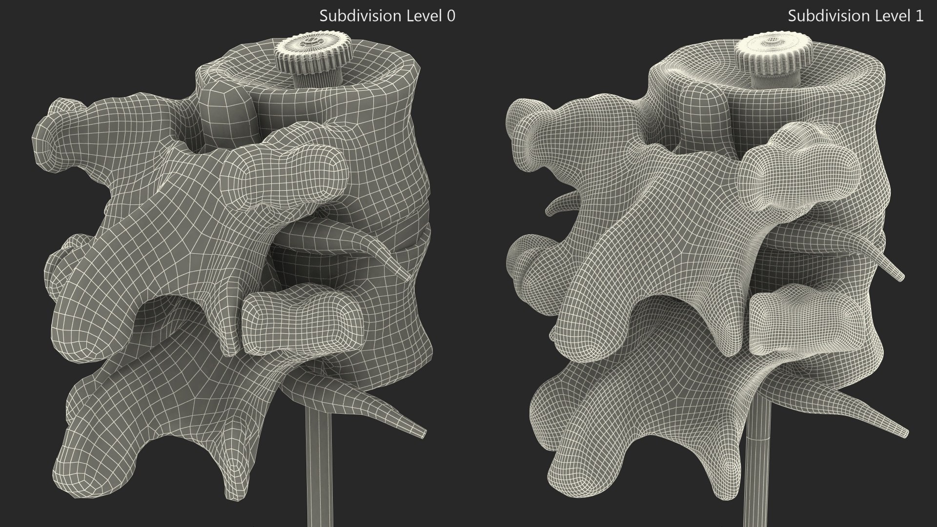 3D Stand With Herniated Spinal Vertebrae Model - TurboSquid 2051054