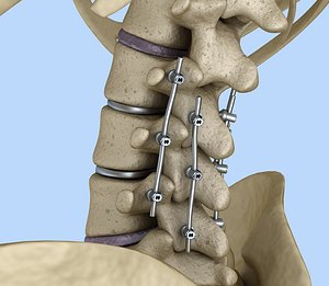 3D model spinal fixation - titanium
