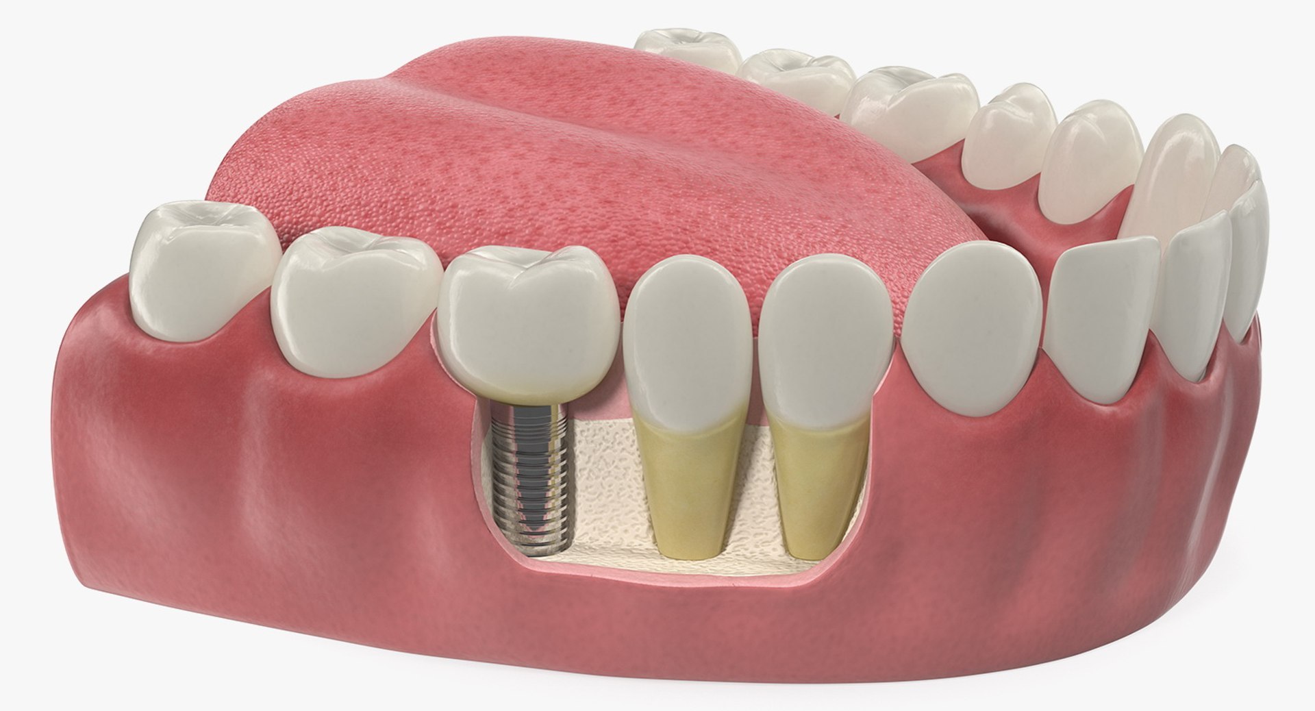 3D Tooth Implants Collection 4 https://p.turbosquid.com/ts-thumb/XR/EkHB9y/2h/toothimplantscollection43dmodel085/jpg/1706530851/1920x1080/fit_q87/03b58015a8cfc00291da33ce0979abc54eb51bbe/toothimplantscollection43dmodel085.jpg