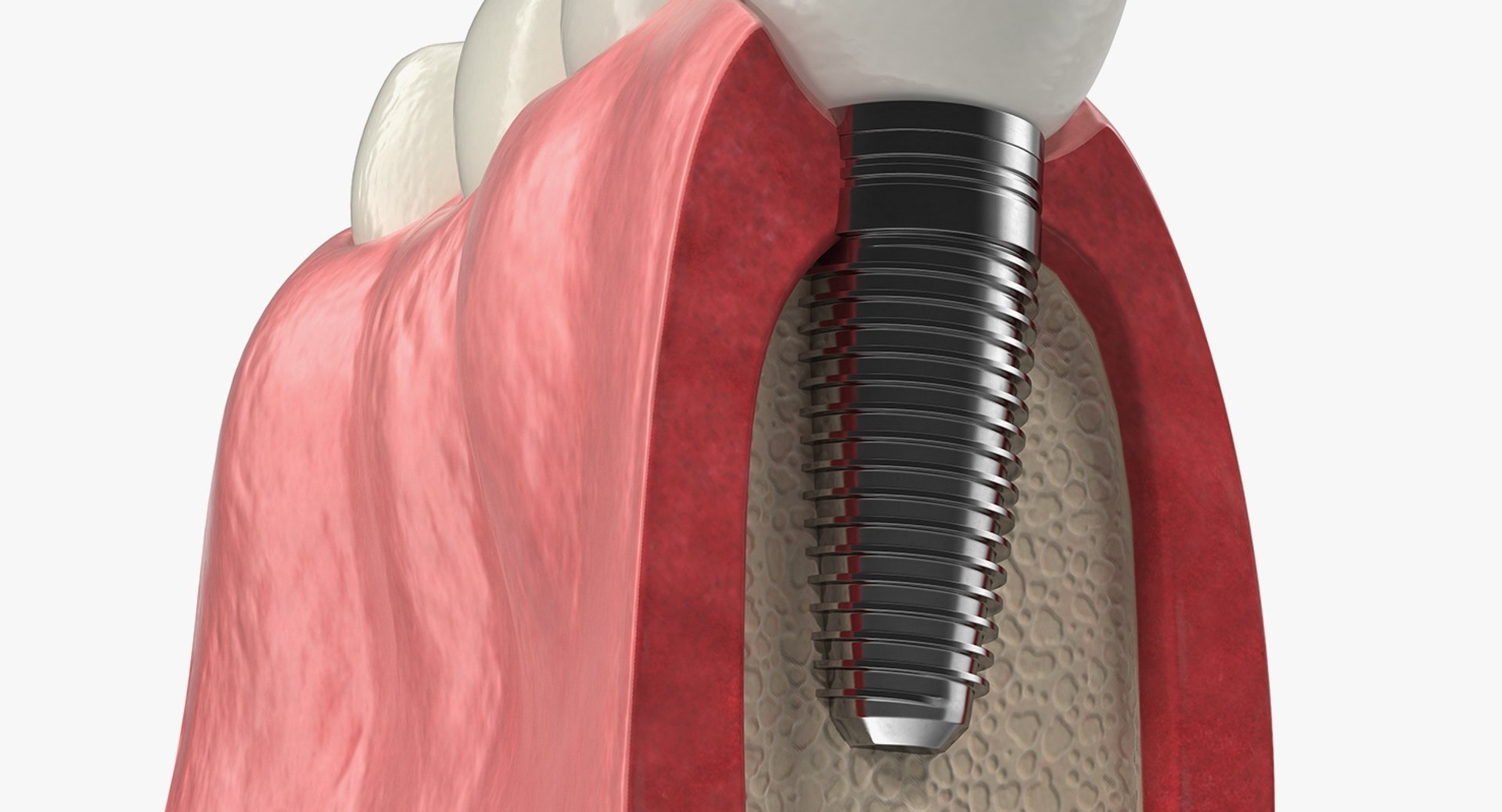 3D Tooth Implants Collection 4 https://p.turbosquid.com/ts-thumb/XR/EkHB9y/8M/toothimplantscollection43dmodel065/jpg/1706530766/1920x1080/fit_q87/abcb63d1d2b9aa7937dfa44dc8cb646bd1108e70/toothimplantscollection43dmodel065.jpg