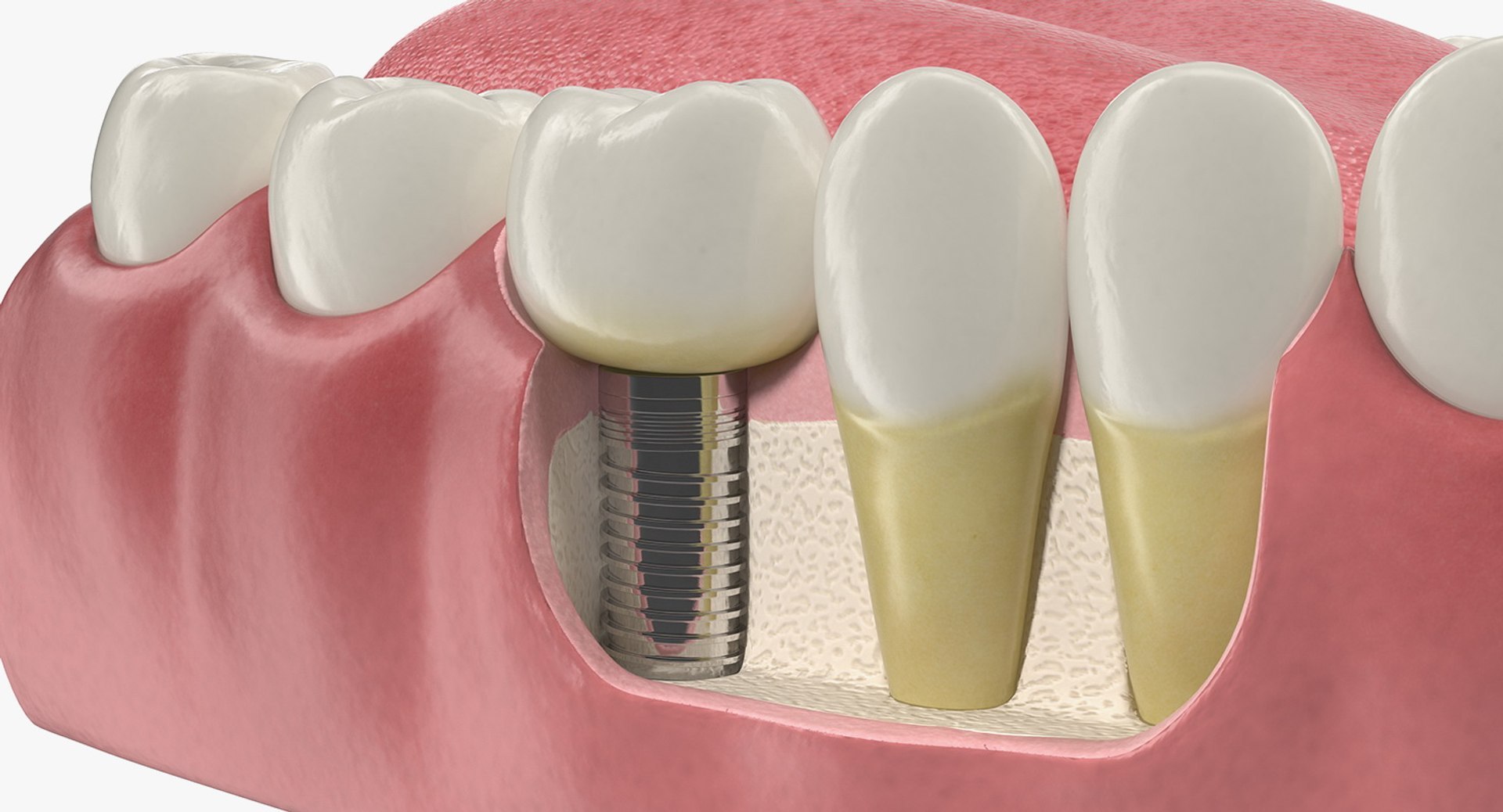 3D Tooth Implants Collection 4 https://p.turbosquid.com/ts-thumb/XR/EkHB9y/BH/toothimplantscollection43dmodel088/jpg/1706530864/1920x1080/fit_q87/9a3f54defb8ed5e9be30a8c8a86076d2cf951823/toothimplantscollection43dmodel088.jpg