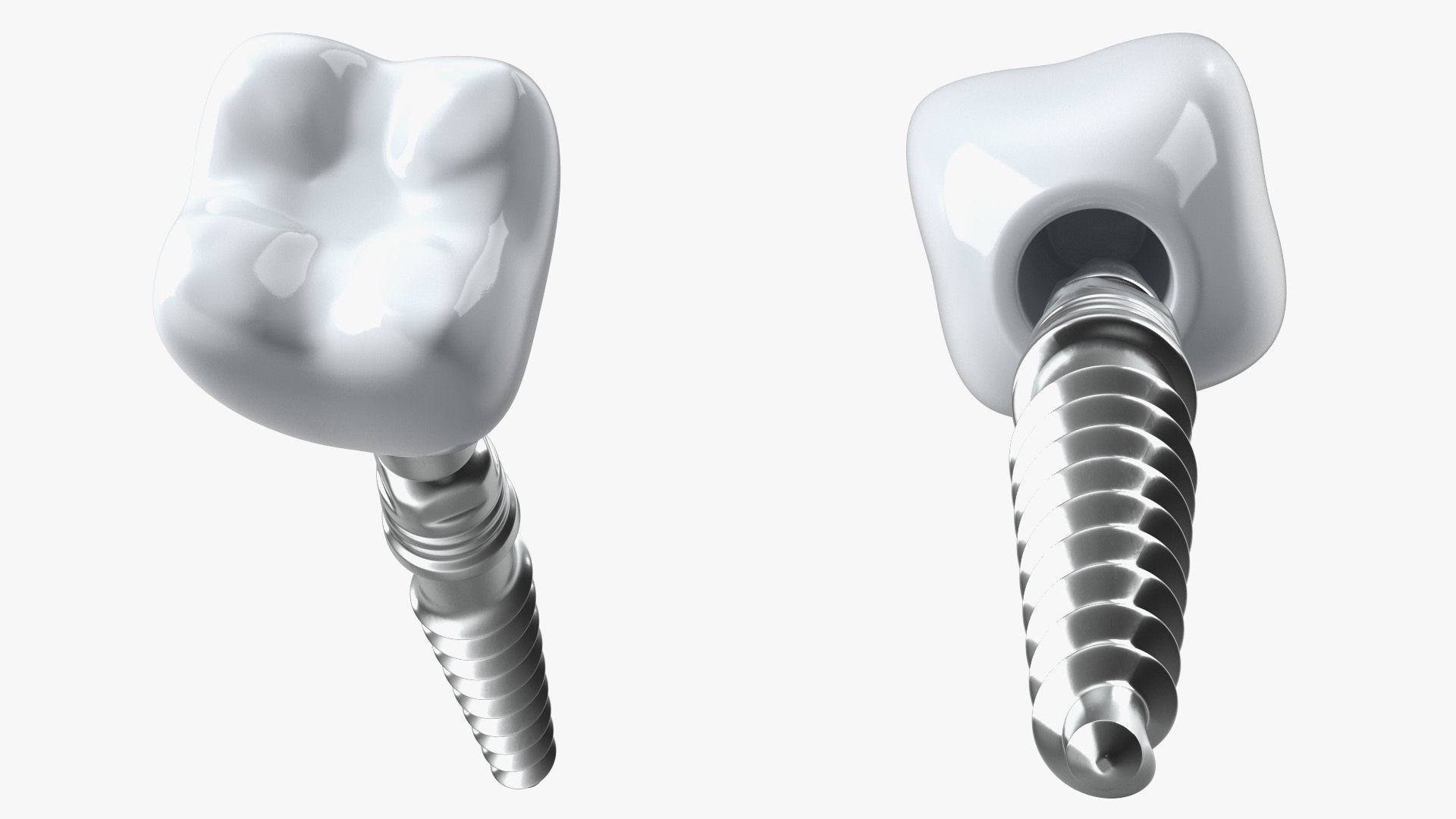3D Tooth Implants Collection 4 https://p.turbosquid.com/ts-thumb/XR/EkHB9y/BP/toothimplantscollection43dmodel022/jpg/1706530573/1920x1080/fit_q87/3412c0052a3a452ff77ff28cc5bb4b57a76248ca/toothimplantscollection43dmodel022.jpg