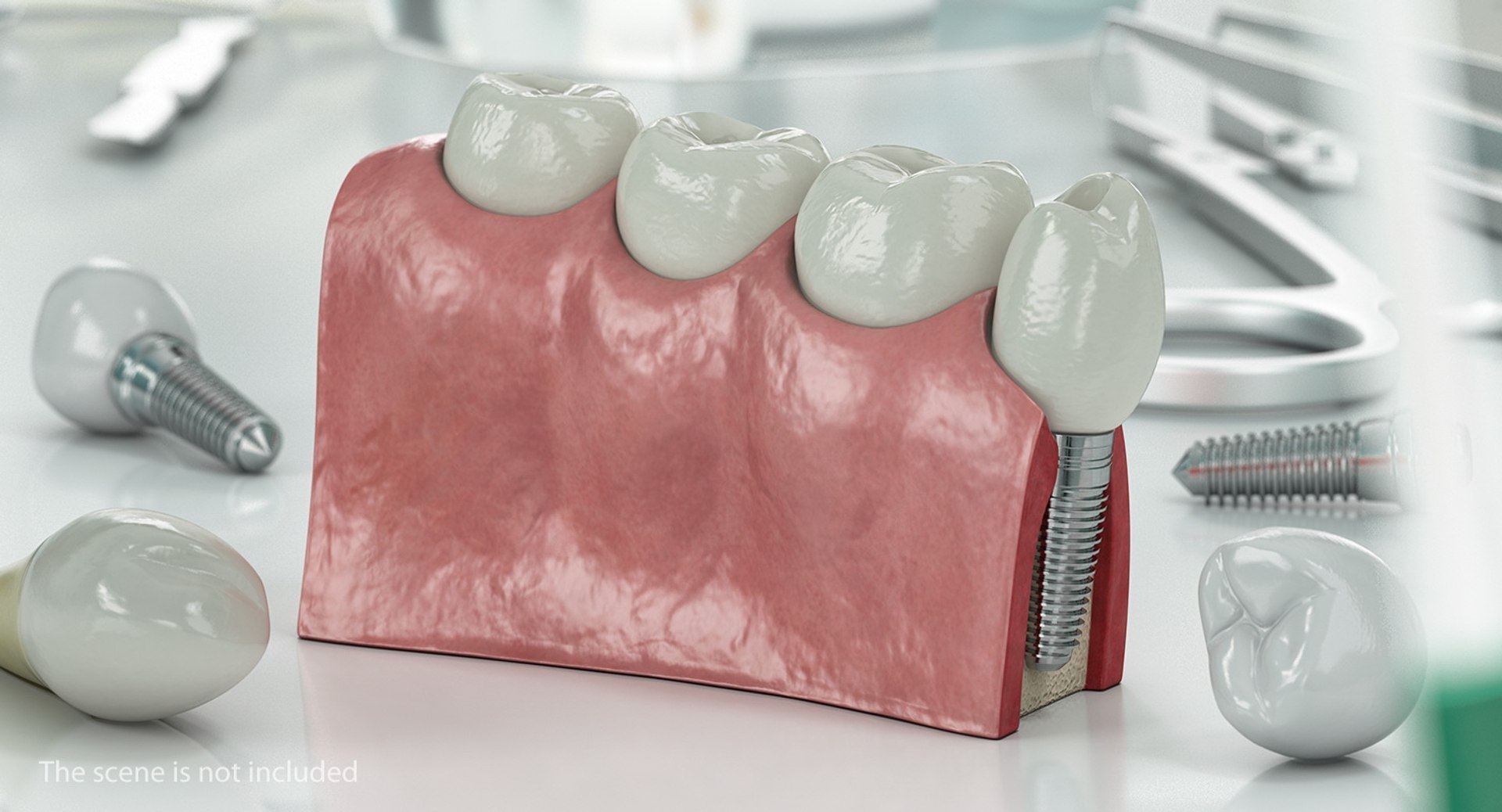 3D Tooth Implants Collection 4 https://p.turbosquid.com/ts-thumb/XR/EkHB9y/TD/toothimplantscollection43dmodel060/jpg/1706530744/1920x1080/fit_q87/02ed2dba4b0fc02dcbbe29df52af69a9bac6db5b/toothimplantscollection43dmodel060.jpg