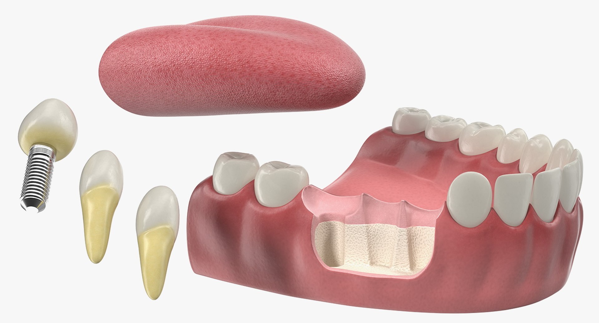 3D Tooth Implants Collection 4 https://p.turbosquid.com/ts-thumb/XR/EkHB9y/Ut/toothimplantscollection43dmodel084/jpg/1706530847/1920x1080/fit_q87/bf17a1216f969defd29ee5477ced9043da394d0e/toothimplantscollection43dmodel084.jpg