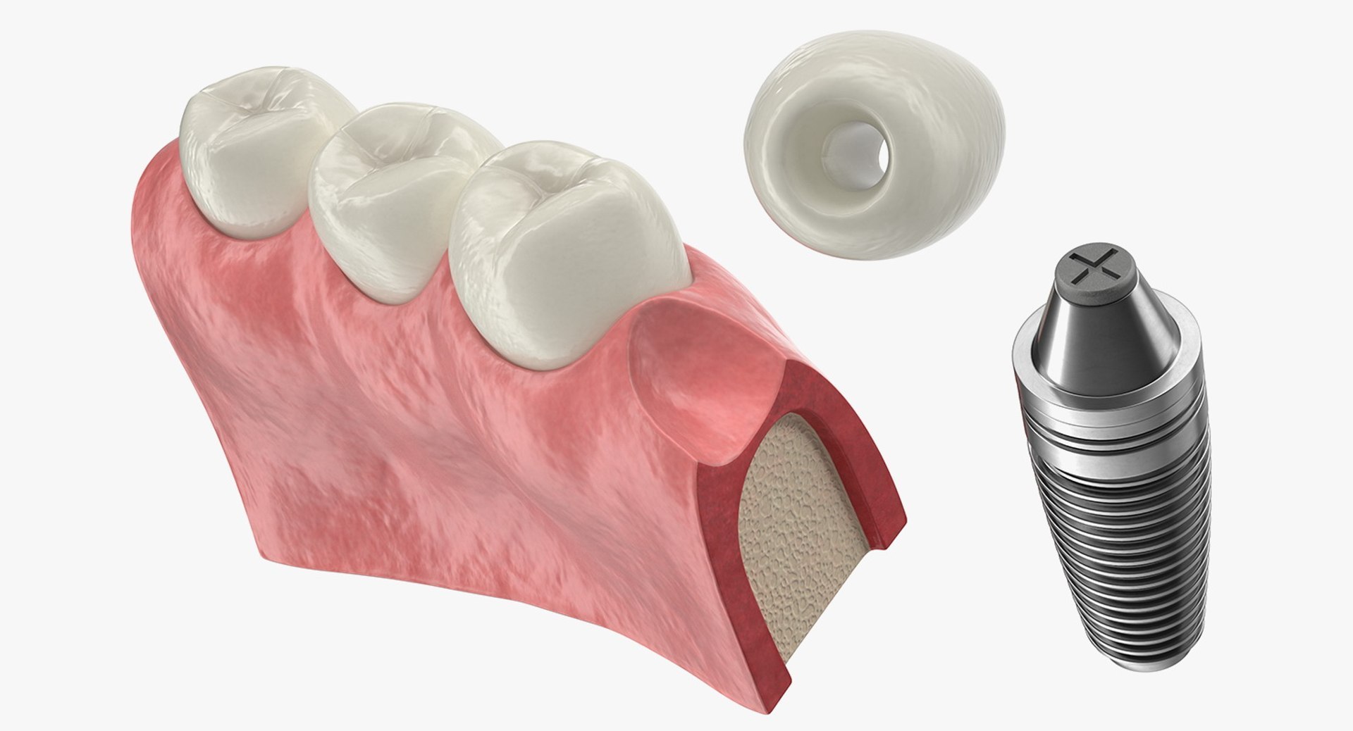 3D Tooth Implants Collection 4 https://p.turbosquid.com/ts-thumb/XR/EkHB9y/YP/toothimplantscollection43dmodel061/jpg/1706530750/1920x1080/fit_q87/1cbbb7ed43ce37c8bdf76781b746bbc3db359844/toothimplantscollection43dmodel061.jpg