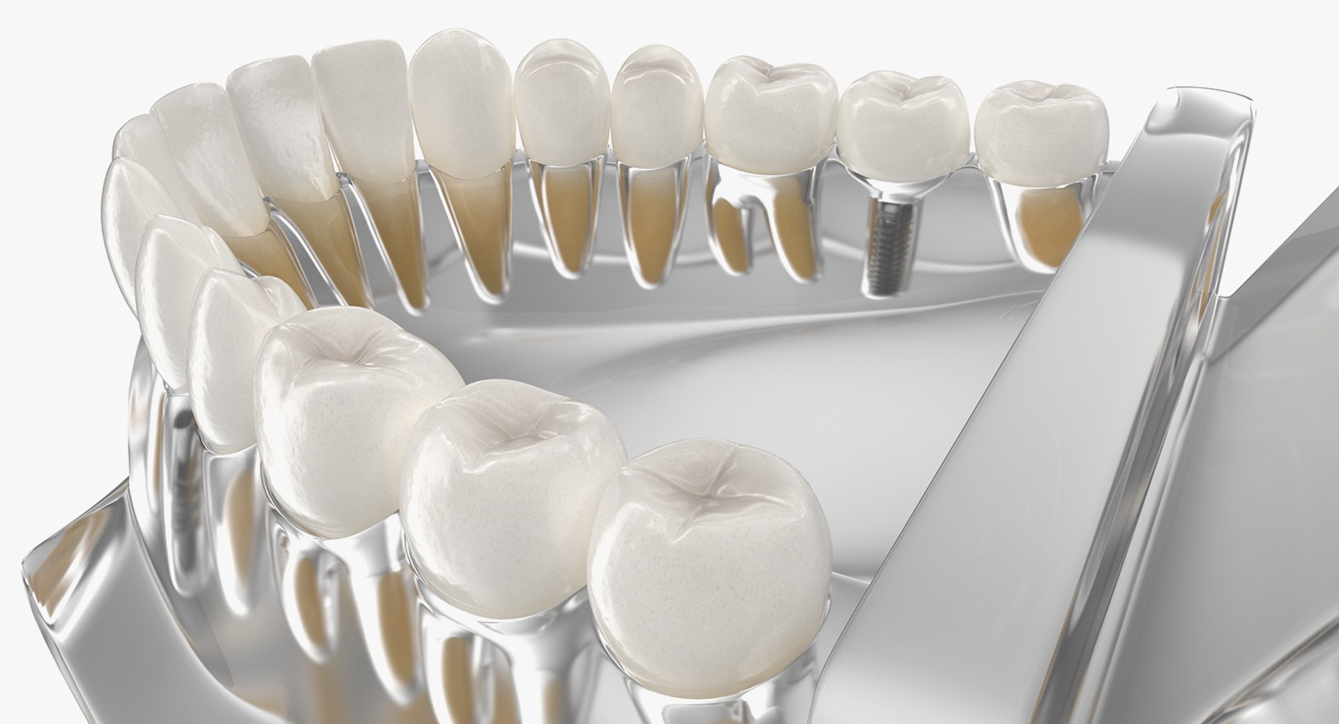 3D Tooth Implants Collection 4 https://p.turbosquid.com/ts-thumb/XR/EkHB9y/eL/toothimplantscollection43dmodel096/jpg/1706530899/1920x1080/fit_q87/ef984066ea58b271ea5182a2197f2cc4b9fc6c1b/toothimplantscollection43dmodel096.jpg