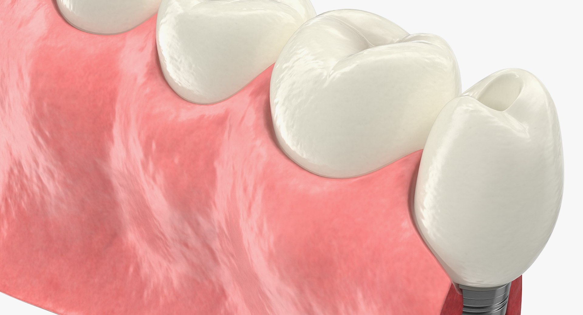 3D Tooth Implants Collection 4 https://p.turbosquid.com/ts-thumb/XR/EkHB9y/hj/toothimplantscollection43dmodel066/jpg/1706530771/1920x1080/fit_q87/8ca7e2dafaa9a6a3a8edfb73dee1efb58bbfde9f/toothimplantscollection43dmodel066.jpg