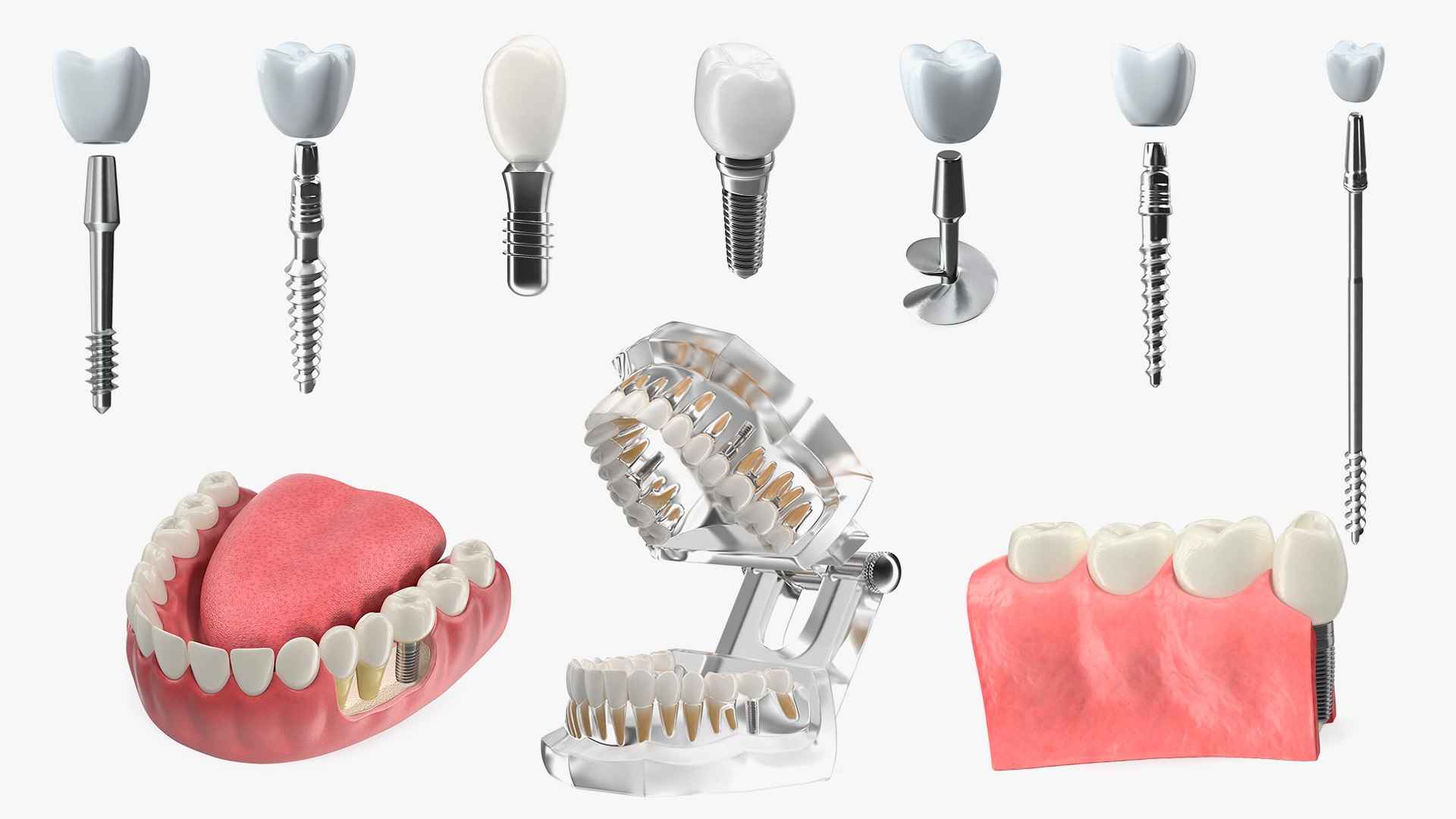 3D Tooth Implants Collection 4 https://p.turbosquid.com/ts-thumb/XR/EkHB9y/no/toothimplantscollection43dmodel001/jpg/1706529294/1920x1080/fit_q87/f79414547852b31dda765313cd81d361cc1509ab/toothimplantscollection43dmodel001.jpg