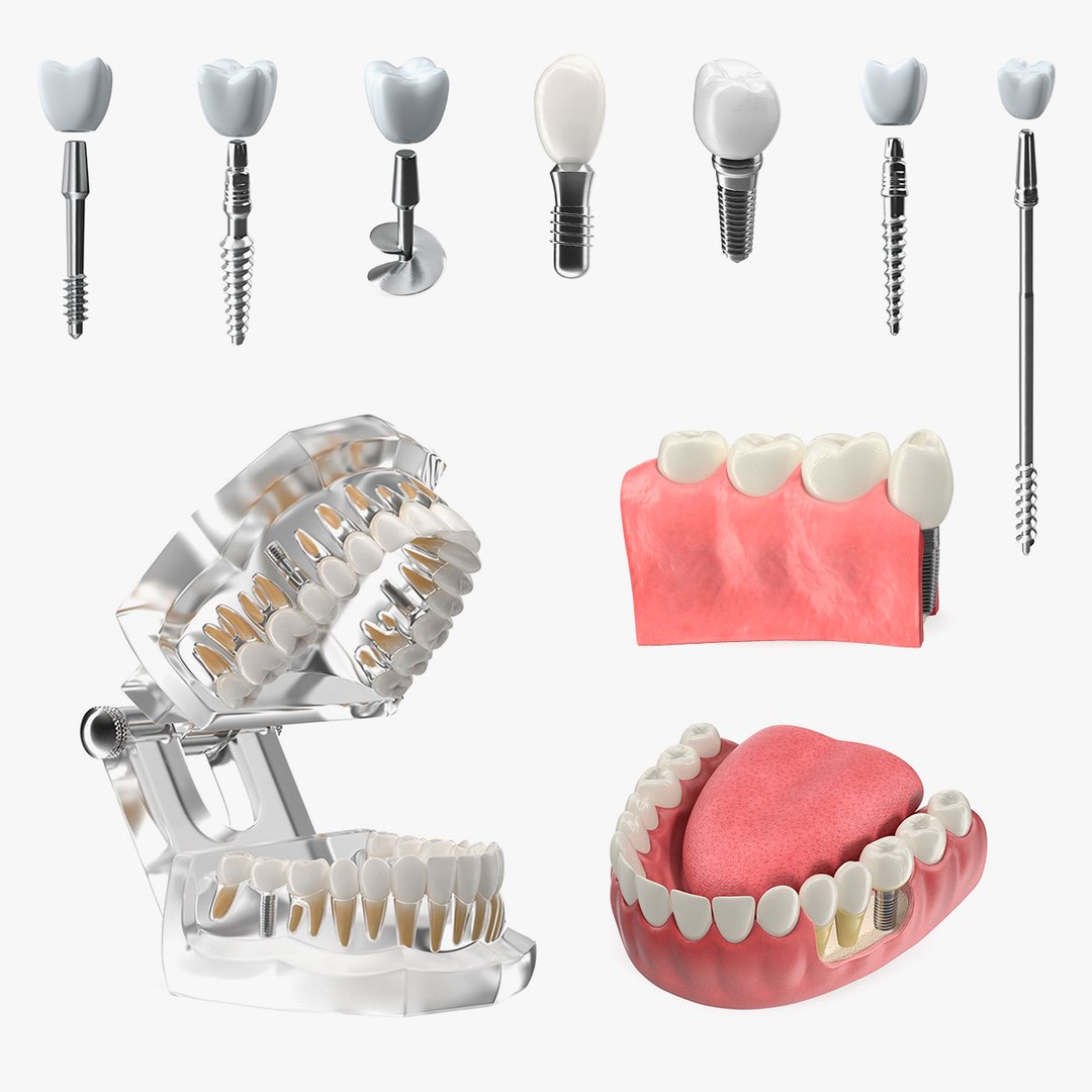Tooth Implants Collection 4 3D model preview