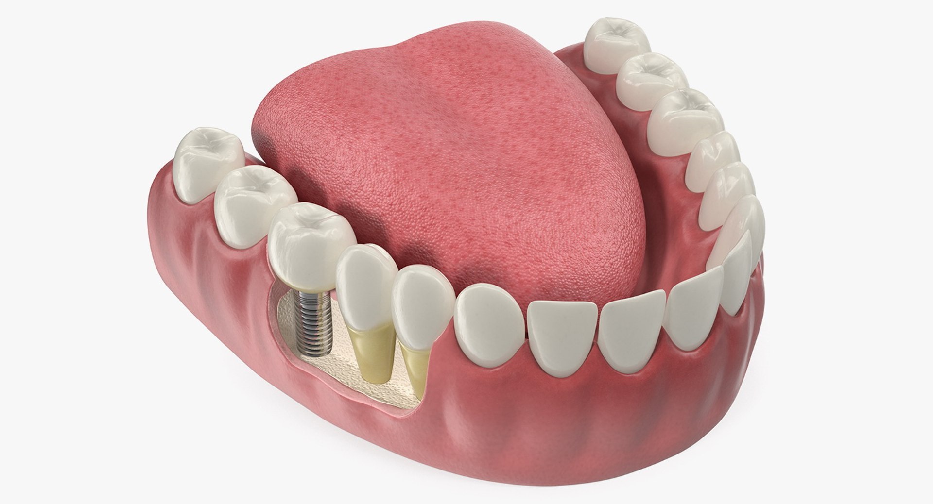 3D Tooth Implants Collection 4 https://p.turbosquid.com/ts-thumb/XR/EkHB9y/ux/toothimplantscollection43dmodel081/jpg/1706530834/1920x1080/fit_q87/468fab01e8e40fdd2c6a73ba681cb2408c4363bb/toothimplantscollection43dmodel081.jpg