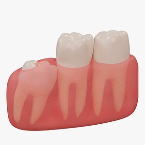 3D model Impacted wisdom teeth