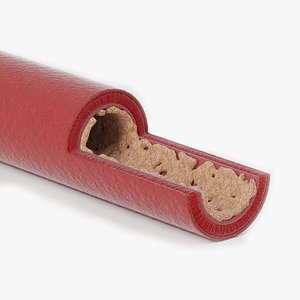 A vessel affected by atherosclerosis