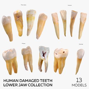 Human Damaged Teeth Lower Jaw Collection - 13 models 3D model