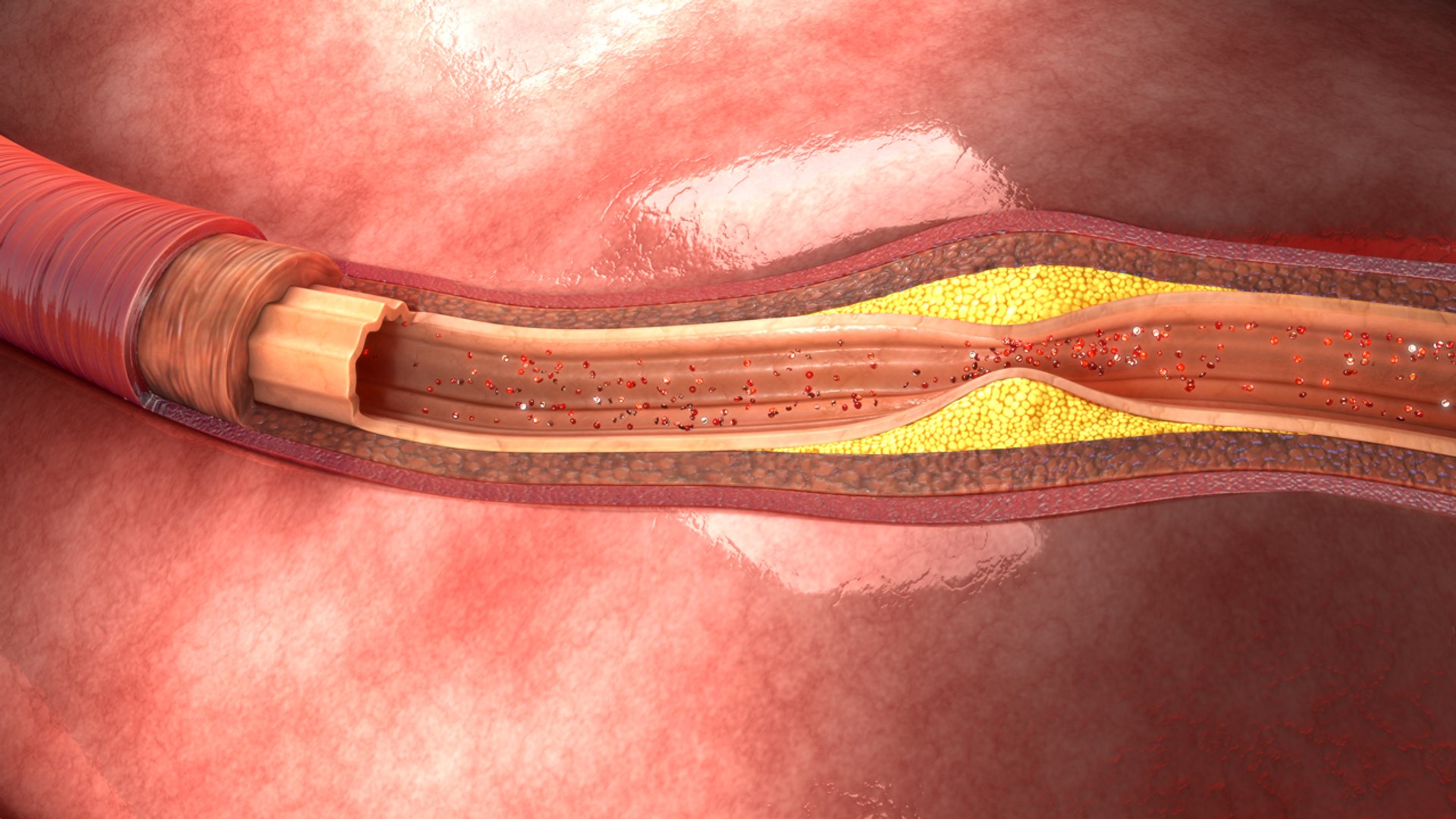 atherosclerosis 3d model https://p.turbosquid.com/ts-thumb/Ye/0S2wdX/7XuB1okL/b0022atherosclerosis_back/jpg/1467102202/1920x1080/fit_q87/105d65c7e6efed0d29c74be72ec3d3b6b1093b4f/b0022atherosclerosis_back.jpg