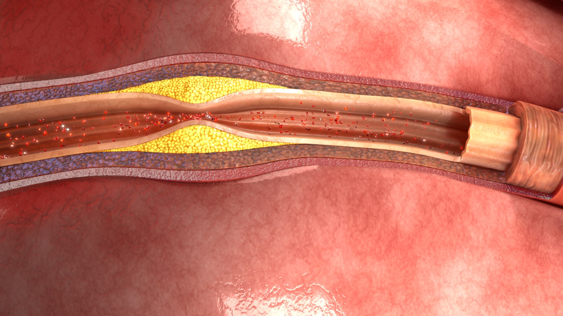 atherosclerosis 3d model https://p.turbosquid.com/ts-thumb/Ye/0S2wdX/HpDUXpZo/b0022atherosclerosis_front/jpg/1467102202/1920x1080/fit_q87/7be8398e169e82159f1a70bca560b4efd4a087e1/b0022atherosclerosis_front.jpg