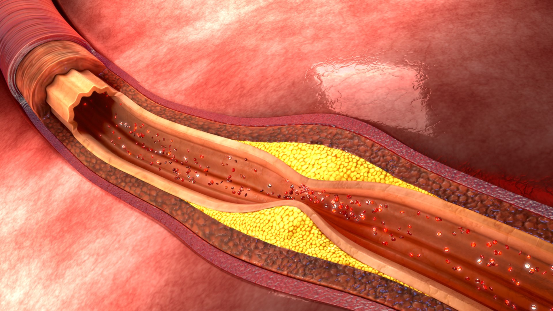 atherosclerosis 3d model https://p.turbosquid.com/ts-thumb/Ye/0S2wdX/VrIe4zsQ/b0022atherosclerosis_perspective/jpg/1467102202/1920x1080/fit_q87/888c77db558bed0435600d0429fc891f4a96ce44/b0022atherosclerosis_perspective.jpg