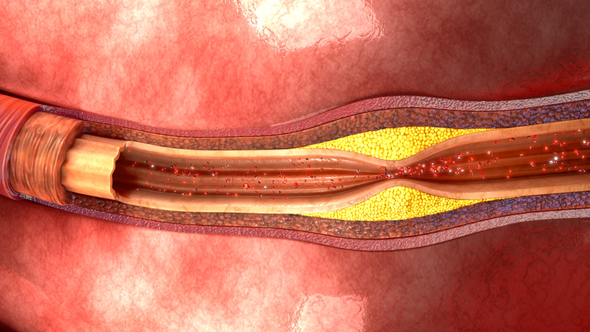 atherosclerosis 3d model https://p.turbosquid.com/ts-thumb/Ye/0S2wdX/cAhqCSn7/b0022atherosclerosis_top/jpg/1467102202/1920x1080/fit_q87/1f13000db439a09f8800f6f43e099805e8593f23/b0022atherosclerosis_top.jpg
