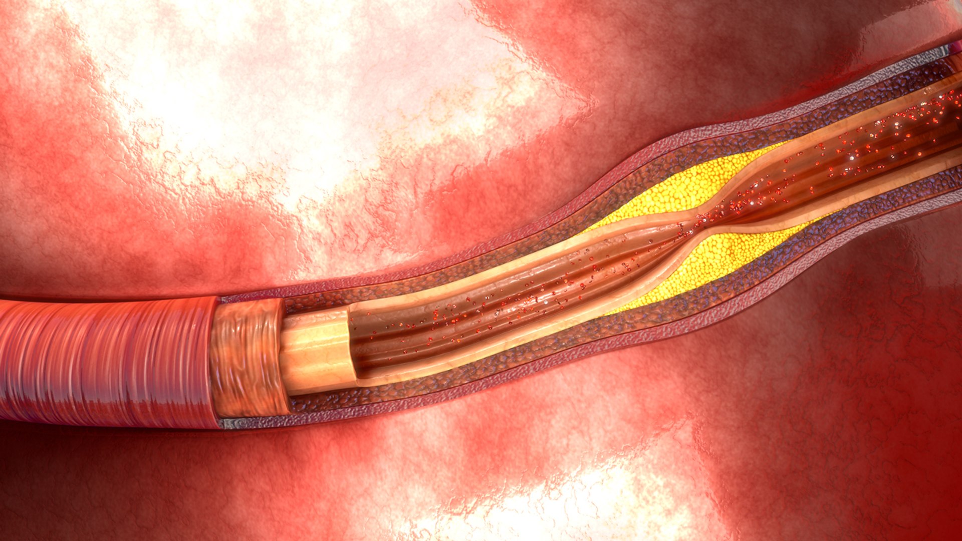 atherosclerosis 3d model https://p.turbosquid.com/ts-thumb/Ye/0S2wdX/iFkGEMmU/b0022atherosclerosis_aerial/jpg/1467102202/1920x1080/fit_q87/a5218a097553a5c8f7c67a564edc1ac28f3a04f4/b0022atherosclerosis_aerial.jpg