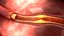 Atherosclerosis
