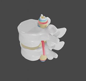 3D slipped disc
