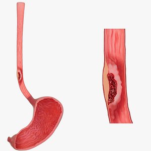 3D model Esophageal ulcer stomach contents animation Human organ