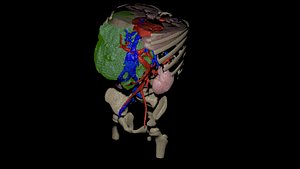 3D tumor kidney model