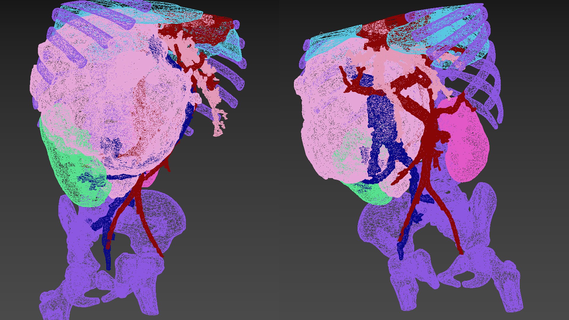 3D tumor kidney model https://p.turbosquid.com/ts-thumb/ZU/pYdbFQ/ai/tk_wire/jpg/1608380892/1920x1080/fit_q87/4cbac3be0f36ed8d718f93cbb068d7e510bcb0cd/tk_wire.jpg