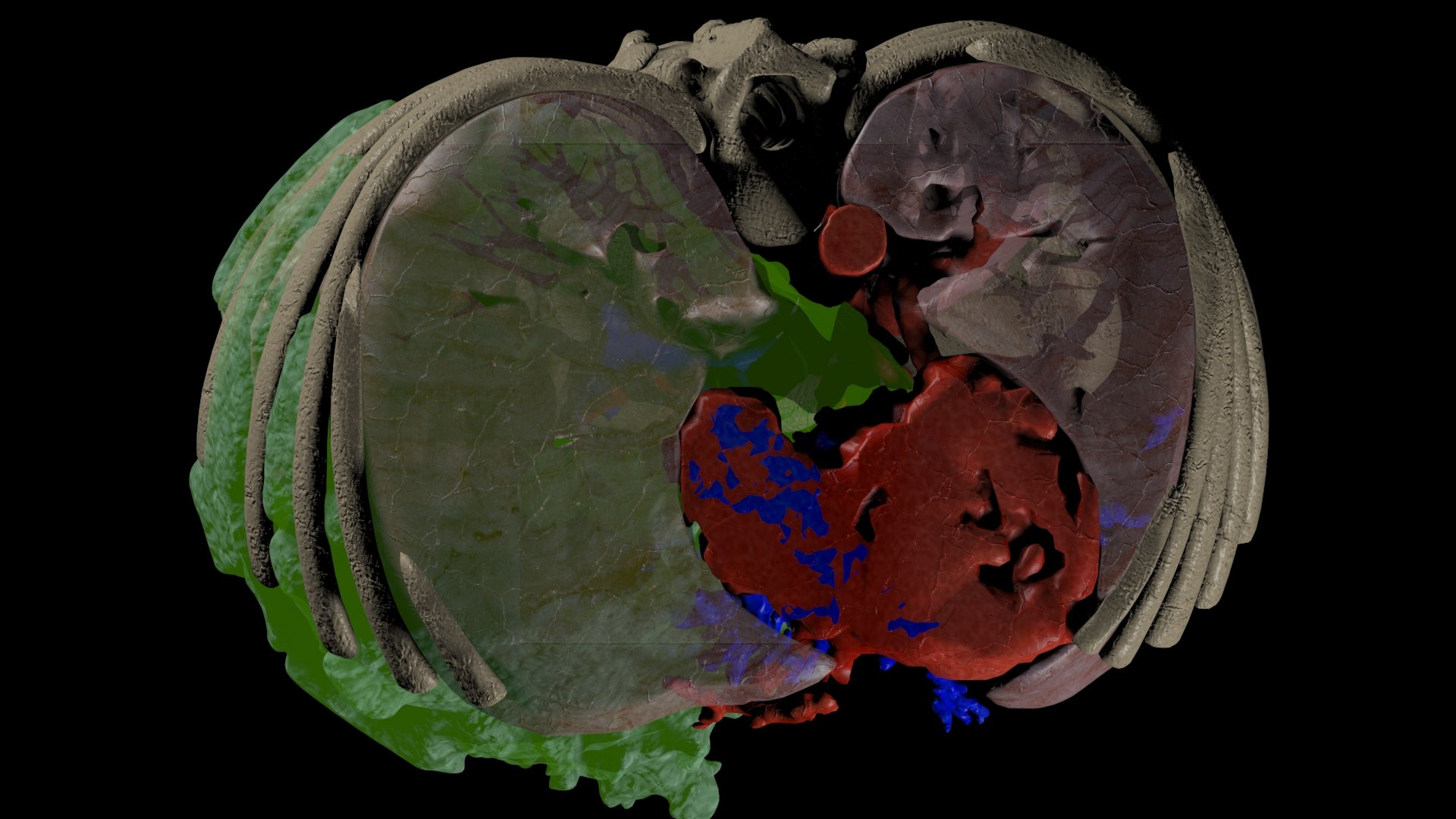 3D tumor kidney model https://p.turbosquid.com/ts-thumb/ZU/pYdbFQ/dT/tk5/jpg/1608380894/1920x1080/fit_q87/459cec69ab8e51dd4d509c3639c89247cd56512a/tk5.jpg