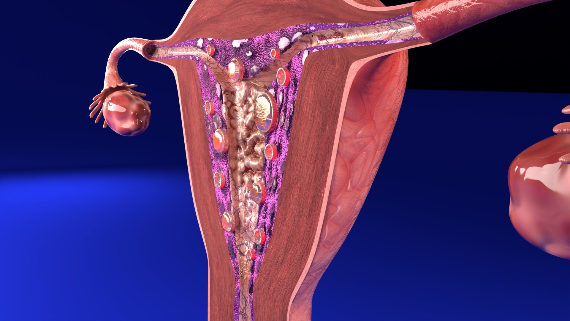 Uterus Endometrial Lesions Model Set - Hyperplasia Polyp Cyst Cancer ...