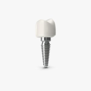 Tooth Implant