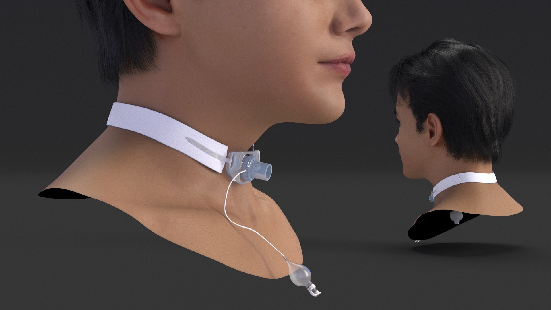 3D Tracheostomy Tube With Neckband Installed On Patient Model ...