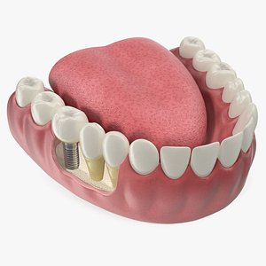 Teeth Tongue Medical Model With Dental Implant